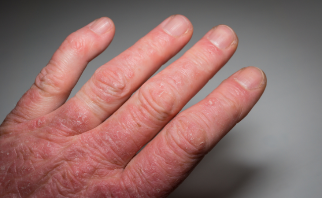 How to Treat Psoriatic Arthritis?