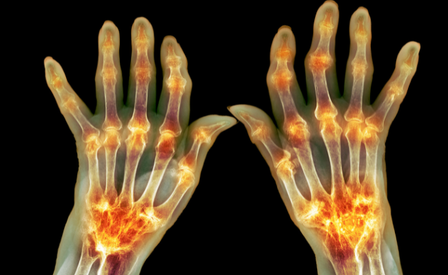 How to Treat Arthritis Rheumatoid?