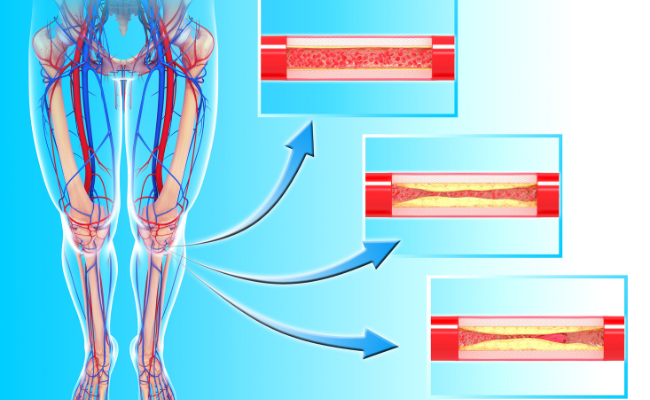 How to Treat Peripheral Arterial Disease?