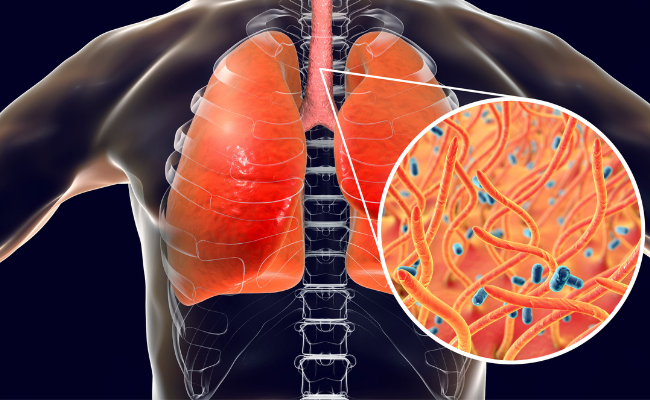 How to Treat Cryptococcosis?