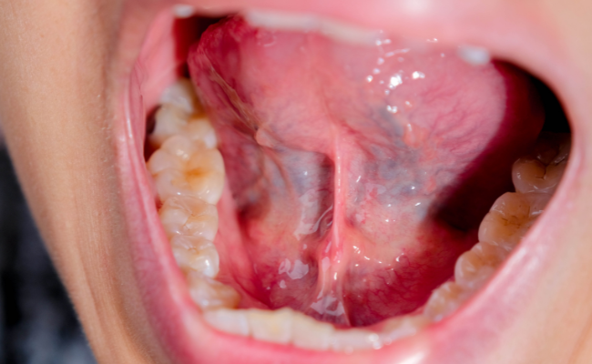 How to Treat Tongue Tie?