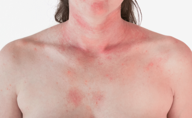 How to Treat Stevens Johnson Syndrome?