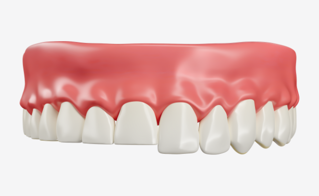 How to Treat Bruxism?