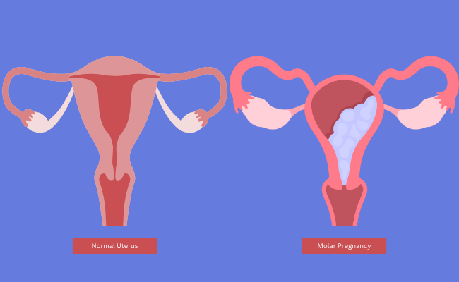 How to Treat Molar Pregnancy?