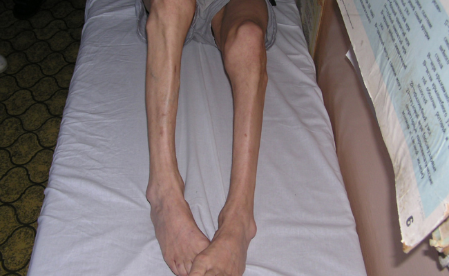 How to Treat Charcot Marie Tooth Disease?