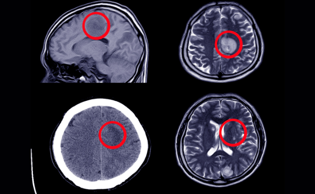 How to Treat Subarachnoid Haemorrhage?