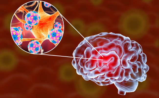 How to Treat Viral Meningoencephalitis?