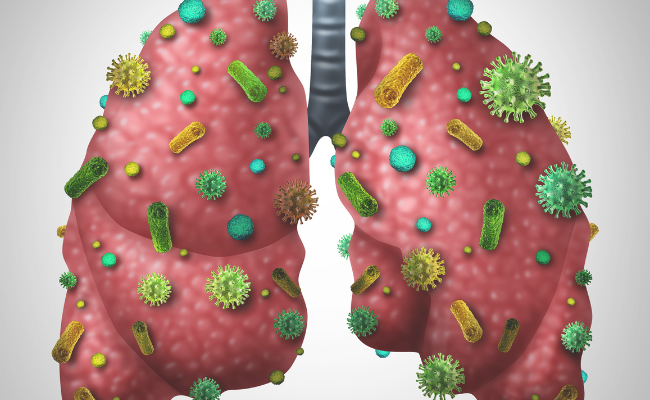 How to Treat Pneumocystis Pneumonia?