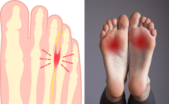 How to Treat Mortons Neuroma?