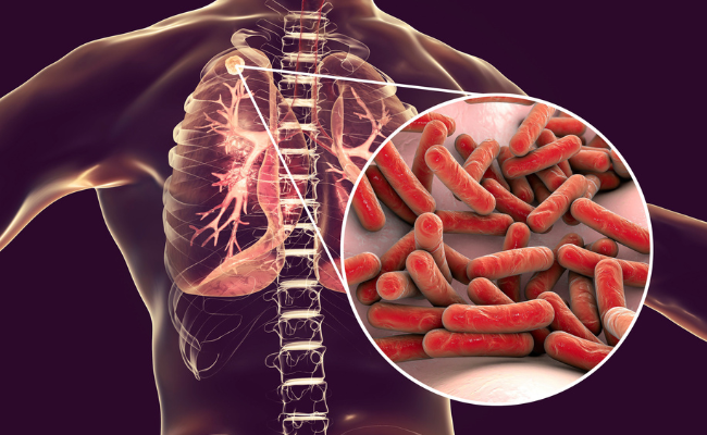 How to Treat Tuberculosis Pleural?