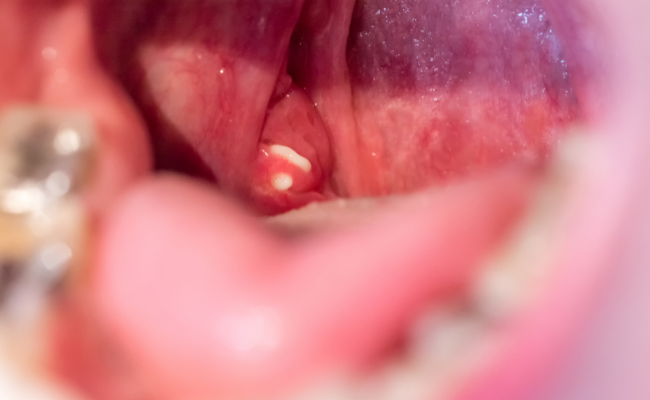 How to Treat Salivary Gland Stones?