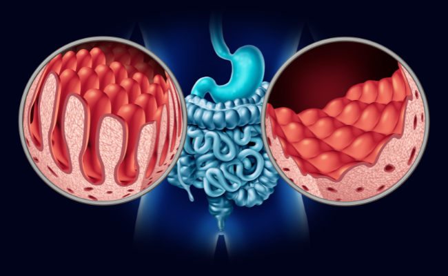 How to Treat Coeliac Disease?