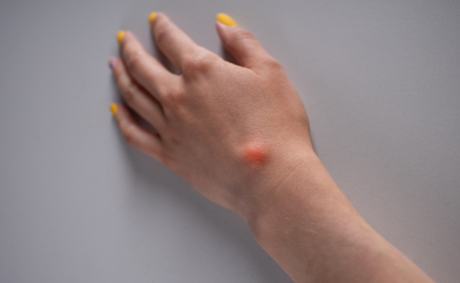 How to Treat Ganglion Cyst?