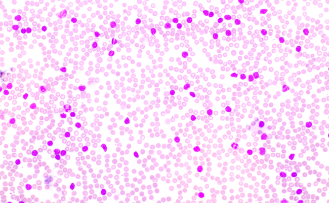 Chronic Lymphocytic Leukemia: Symptoms and Treatment