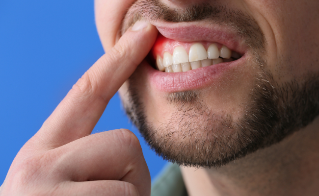 How to Treat Dental Abscess?