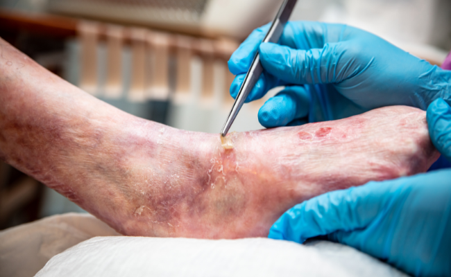 How to Treat Epidermolysis Bullosa?