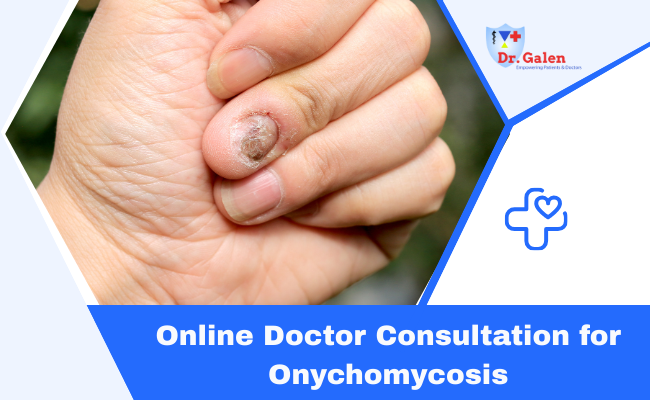Online Doctor Consultation for Onychomycosis