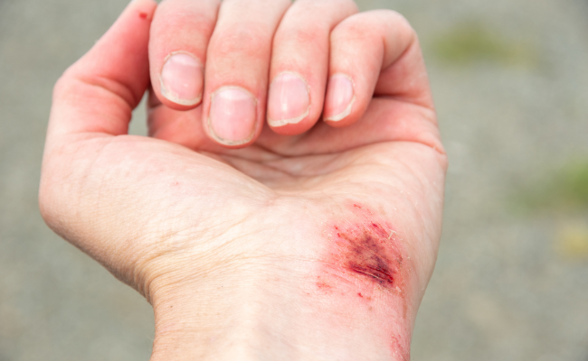 How to Treat Road Rash and Abrasions?