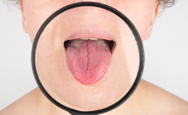 Health Issues: Coated Tongue, Choking, Fatigue