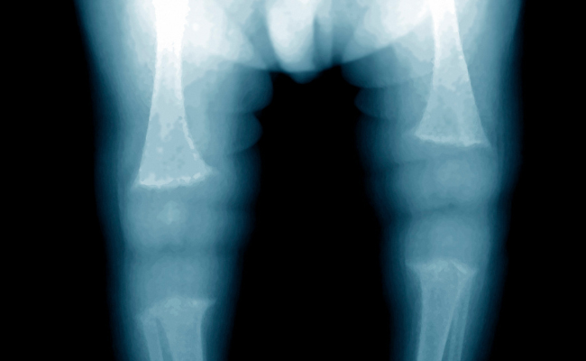 Managing Rickets in Children: Treatments and Cure