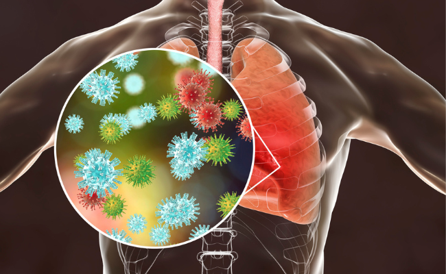 Causes of Respiratory Diseases: A Comprehensive Overview