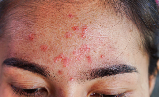 Long-term Acne Treatment: Antibiotics and Relief