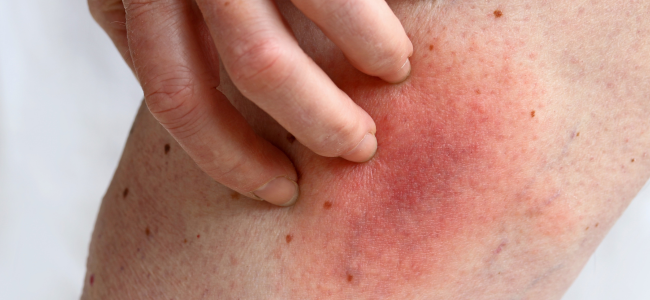 Are Swollen Lymph Nodes and Rashes Normal After a Flu Vaccine?