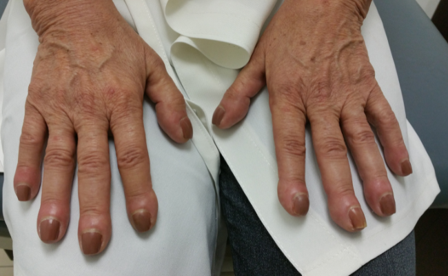 Finger Clubbing: Lung Cancer or Others?