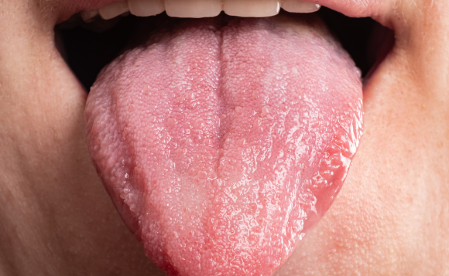 What Causes White Bumps on the Tongue?