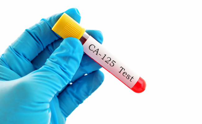 Understanding CA-125 Test Results
