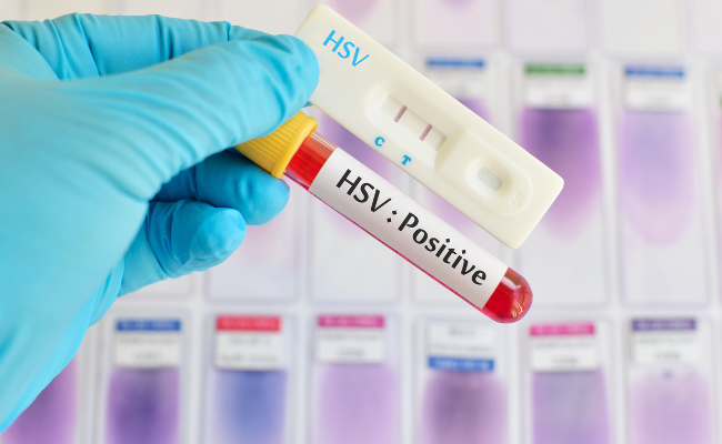 Can HSV-1 be transmitted genitally?