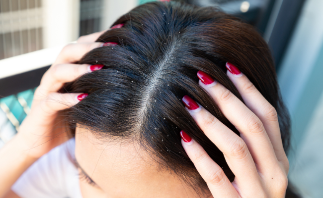 Is Hair Coloring Safe with Scalp Psoriasis?