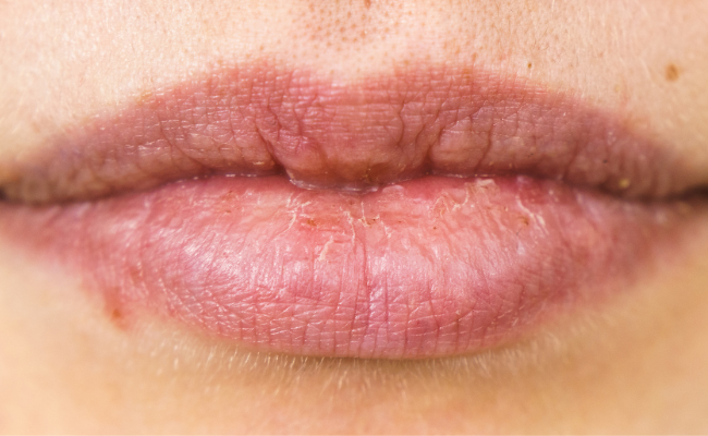 Potential Causes of Small Lip Bumps