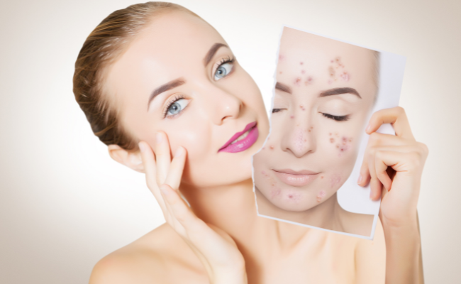 How do effectively treat acne scars?