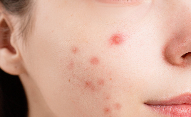 Pimples and Acne: Causes and Treatment