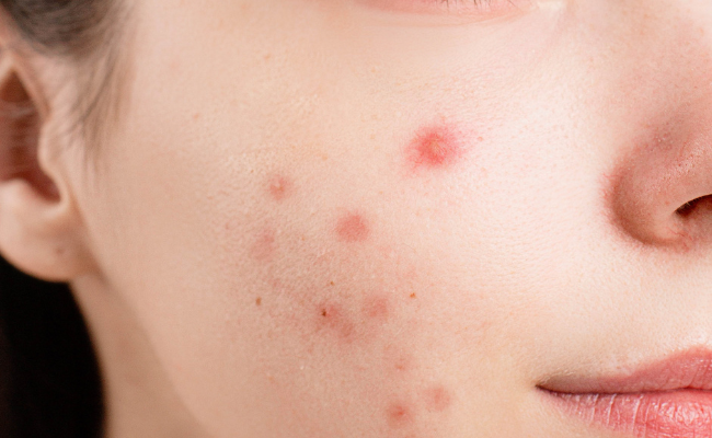 Pimples Unveiled: Causes, and Solutions