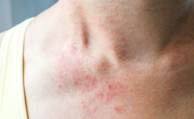 Eczema Flare-Ups: Normal? Effective Management?