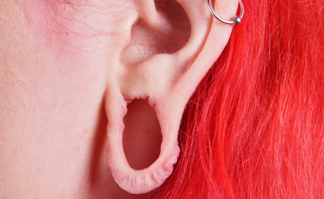 Restoring Lost Earlobe: Stitching After Keloid Surgery