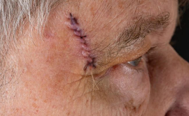 Suture Treatment for Facial Injuries: Healing and Removal Possibilities