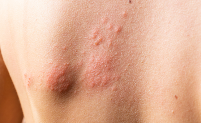 Treating Itchy Breast Rashes: Effective Solutions?