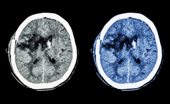 Treatment options for bilateral basal ganglia calcification