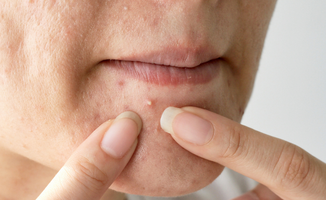 Is Cystic Acne a Serious Concern?