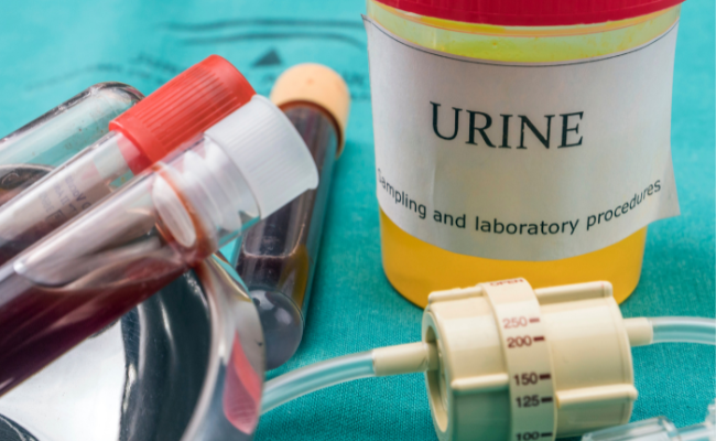Can Alcohol Cause Blood in Urine?