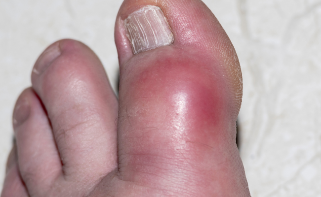 Toe Fracture No Progress, Pain Relief?