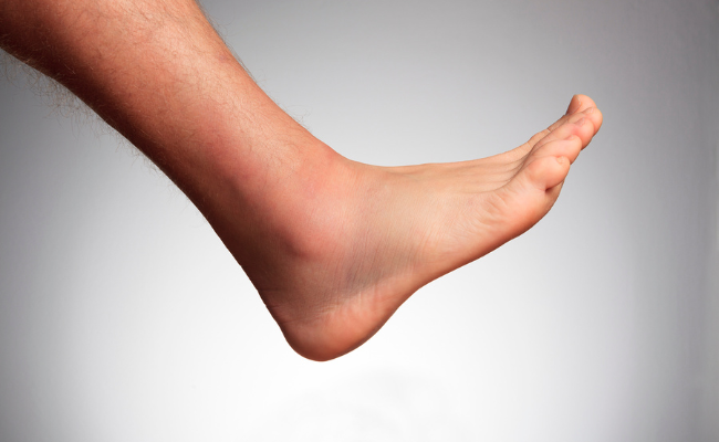 What's causing foot swelling and bruising?