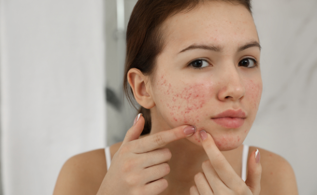 Soothing solutions for redness after blackhead removal