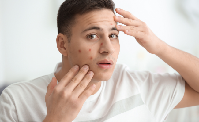 What Causes Infected Pimples and Symptoms?