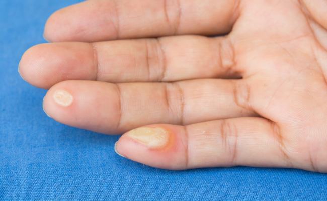What Causes Painful Bumps on Fingers?