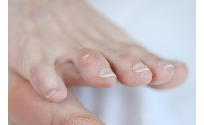 Understanding Foot Calluses: Causes, Treatment, and Prevention