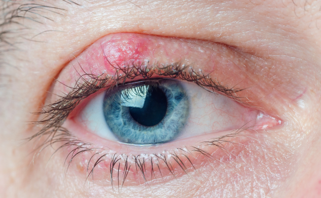What Causes Chalazion Eye Soreness?